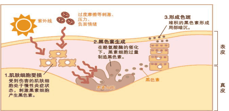 原来痘印有这么多种？看了后能解决你90%的问题